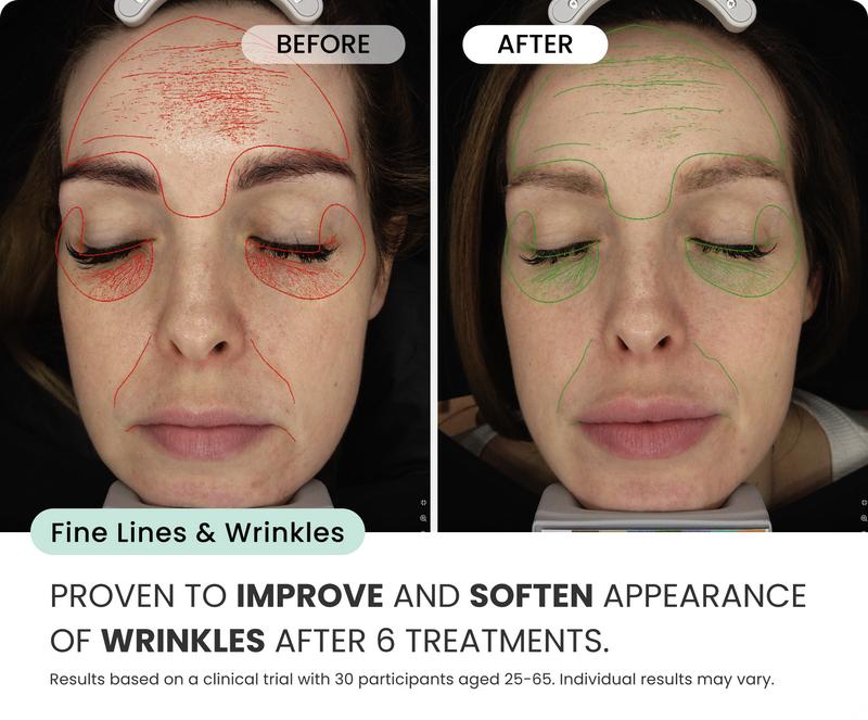 Qure Micro-Infusion (For Wrinkles + Dark Spots)